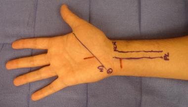 Two red lines show correct locations of incisions 