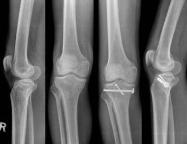 Type IV medial tibial condyle fracture treated wit