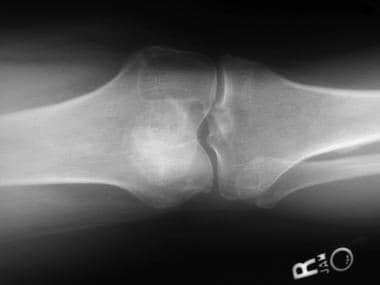 Typical plain radiograph of knee in patient with s