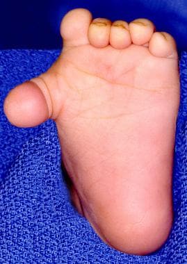 Duplication of Rt foot with indistinguishable big toe.