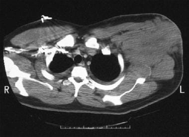 Computed tomography scan in a patient with a large