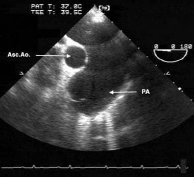 This transesophageal echocardiographic image is fr
