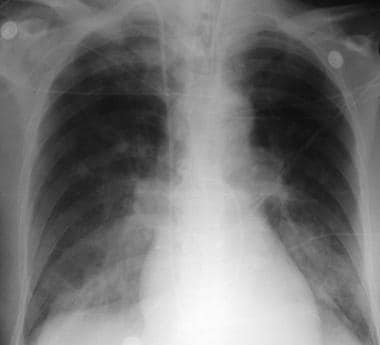 射线照片显示在杆的急性肺水肿