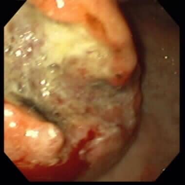 Peptic ulcer disease. Gastric cancer. Note the irr