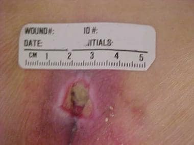 Wound Care Treatment & Management: Medical Care, Surgical Care, Future and  Controversies