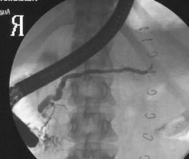 Familial adenomatous polyposis syndrome in a patie