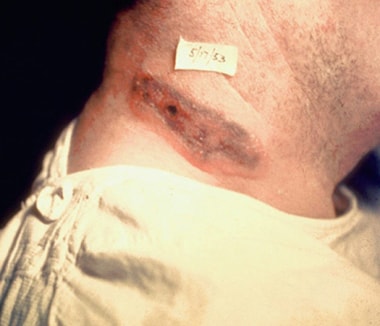 Skin lesions of anthrax on neck. Cutaneous anthrax