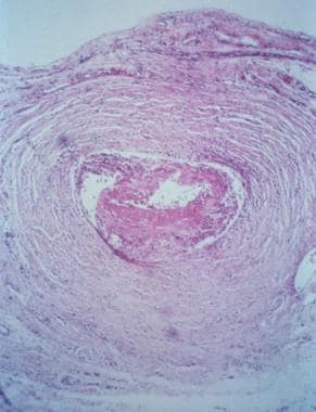 Thrombosed cystic artery in childhood polyarteriti
