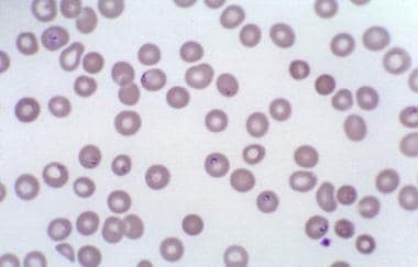 Blood smear showing likely babesiosis. Babesiosis 
