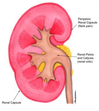 Woman suffering from low back pain with kidney anatomy shape. Cause of flank  pain include urinary tract infection, kidney infection, kidney stone, an  injury or kidney cancer. Nephrology concept. Stock Photo