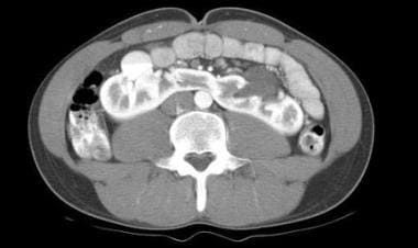 This CT scan demonstrates the isthmus of a horsesh
