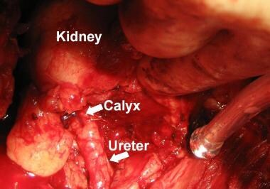 The ureter has been spatulated and anastomosed to 