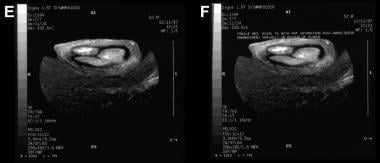 Postcontrast MRI of the penis in the axial plane (