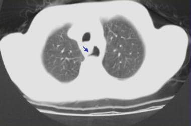 Esophageal Rupture and Tears in Emergency Medicine