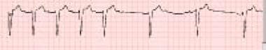 Beta-blocker toxicity. Bradycardia is evident on a