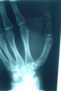 Dislocations, wrist. Anteroposterior (AP) view of 