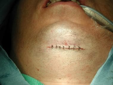 Submental incision closed. 