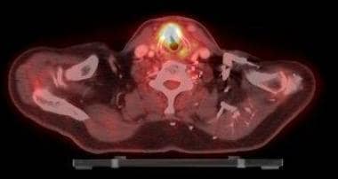 PET/CT image of a laryngeal cancer showing increas