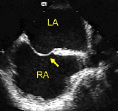 Transesophageal echocardiogram showing the atrial 