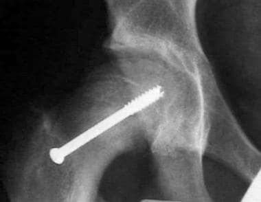 X-ray of a hip following operative percutaneous fi