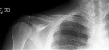 Anteroposterior view of middle third clavicle frac