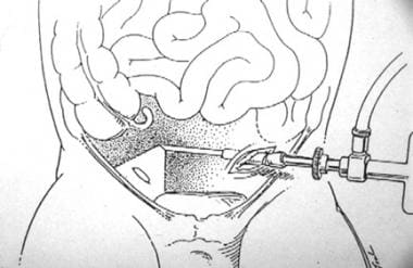 Illustration of the technique for intraoperative d