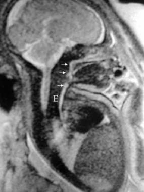 Fetal MRI showing normal esophagus. This study is 