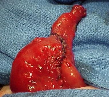 End-to-side anastomosis created in infant with com