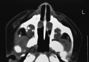 Axial CT scan through the inferior nasal cavities,