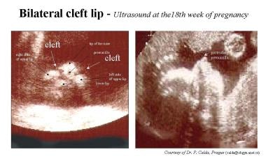 Bilateral cleft lip on ultrasound. 