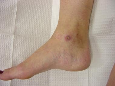 Varicose Veins  Johns Hopkins Medicine