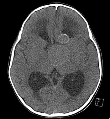 Non-contrast Head CT with peripheral calcification