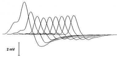 A typical decrementing response to repetitive nerv