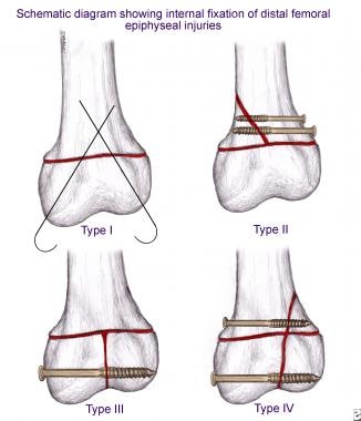 Comminuted Displaced Left Leg Fracture and Intramedullary Rod Fixation