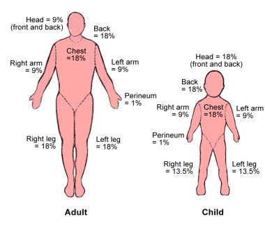 Rule Of 9 S For Burns Chart