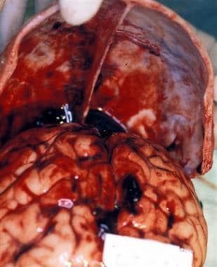 Acute subdural blood over the cerebral convexities