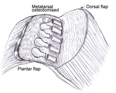 Metatarsal heads have been osteotomized. 