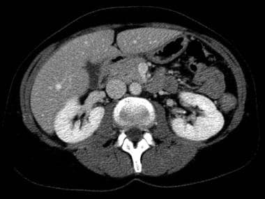 CT urogram: Nephrographic phase image of the kidne