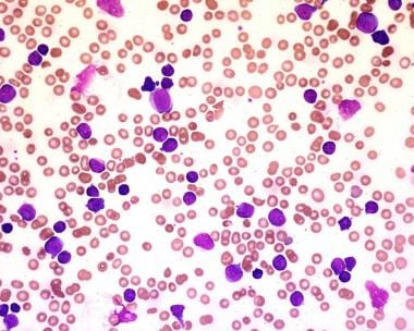 chronic leukemia vs acute leukemia