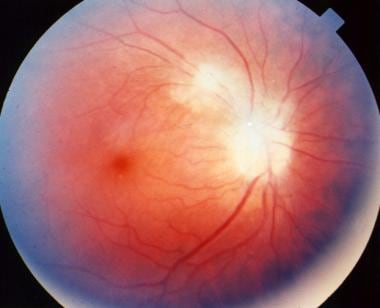 toxoplasmosis retina