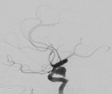 Cerebral angiogram was performed in a 57-year-old 