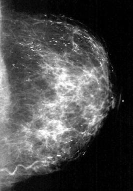 Mammogram - calcifications Information