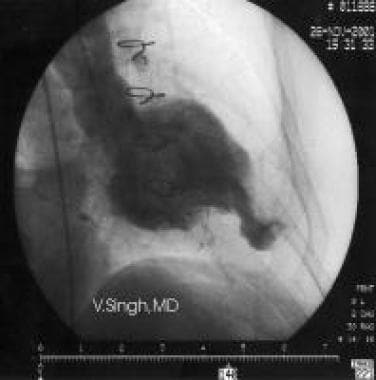 Acute Myocardial Infarction Imaging: Practice Essentials, Radiography, Computed Tomography