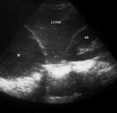Ultrasonogram of the lower right chest. A hypoecho