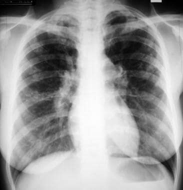 Sarcoidosis, thoracic. Stage II disease. Chest rad