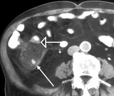 Perforated appendicitis with abscess; computed tom