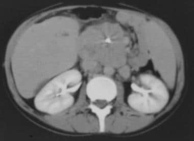 Computed tomography (CT) scan in a patient with fi