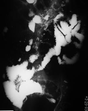 Sprue. Radiograph from a small-bowel series in the