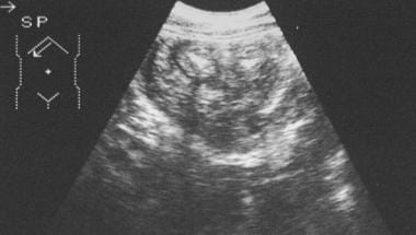 Abdominal sonogram in a 16-year-old male adolescen