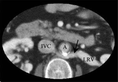 Axial CT scan in a renal transplant donor: Note th